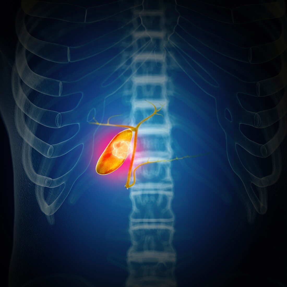 Illustration of gallbladder cancer