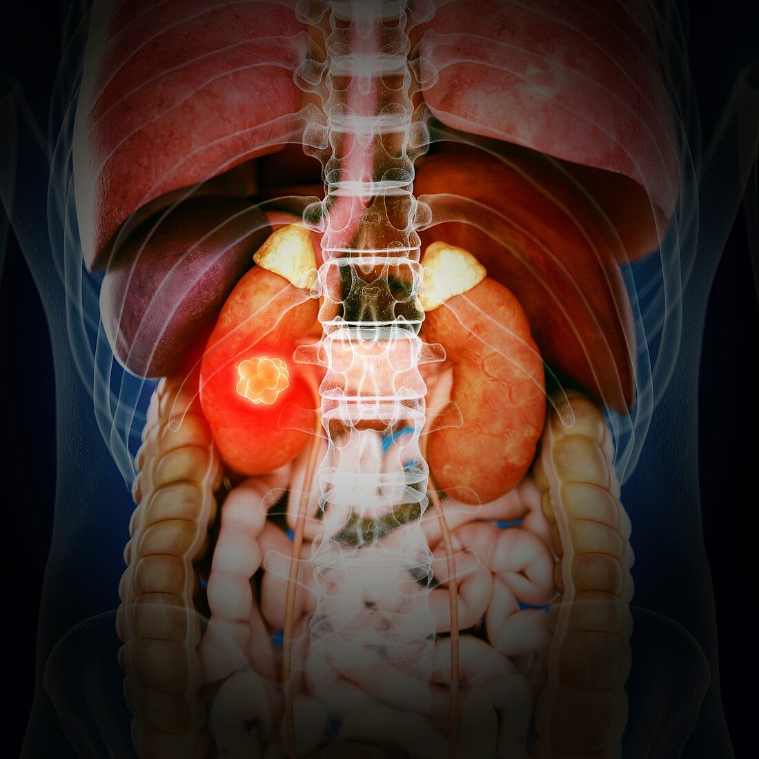 Illustration of kidney cancer