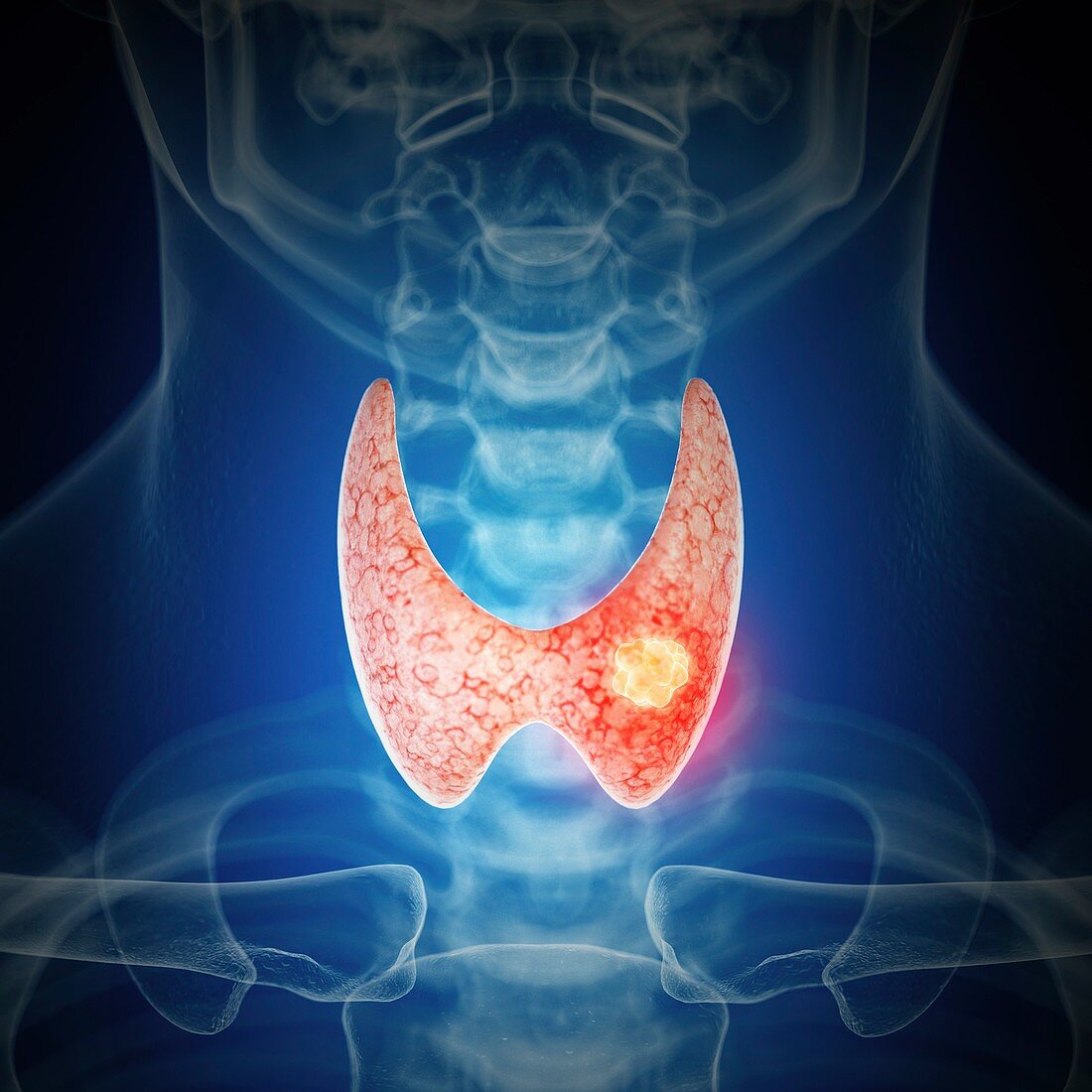 Illustration of thyroid cancer