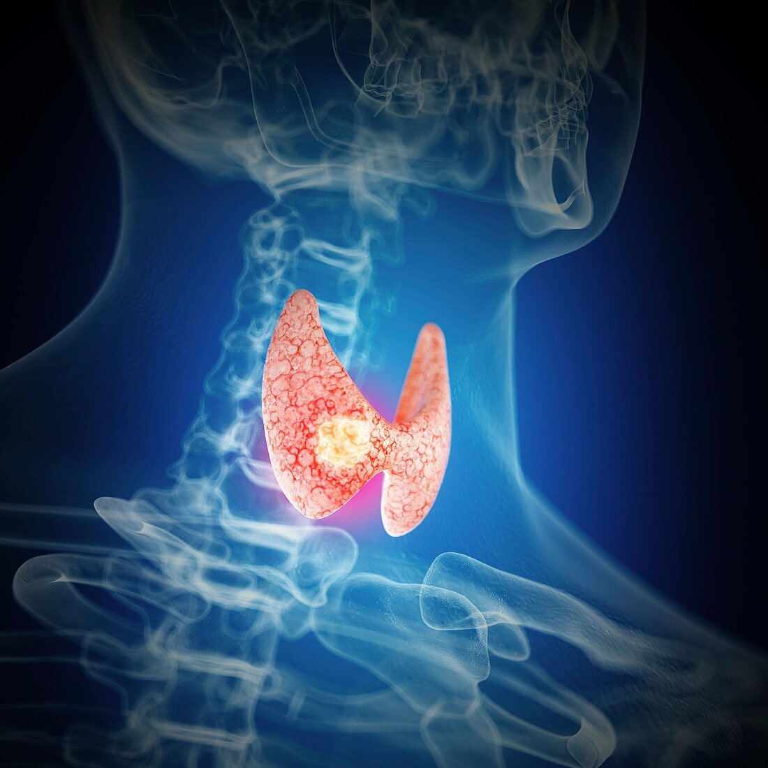 Illustration of thyroid cancer