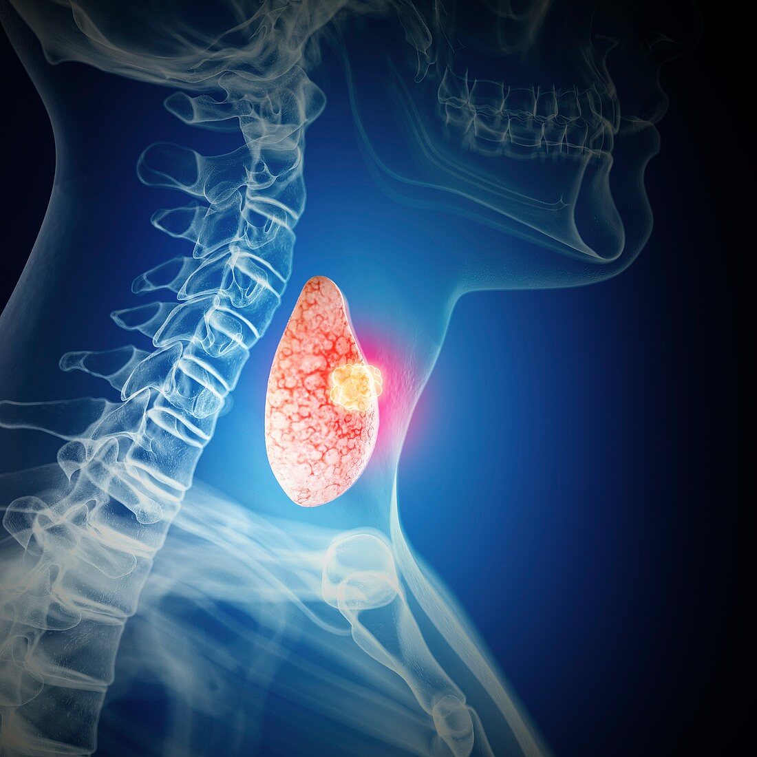 Illustration of thyroid cancer