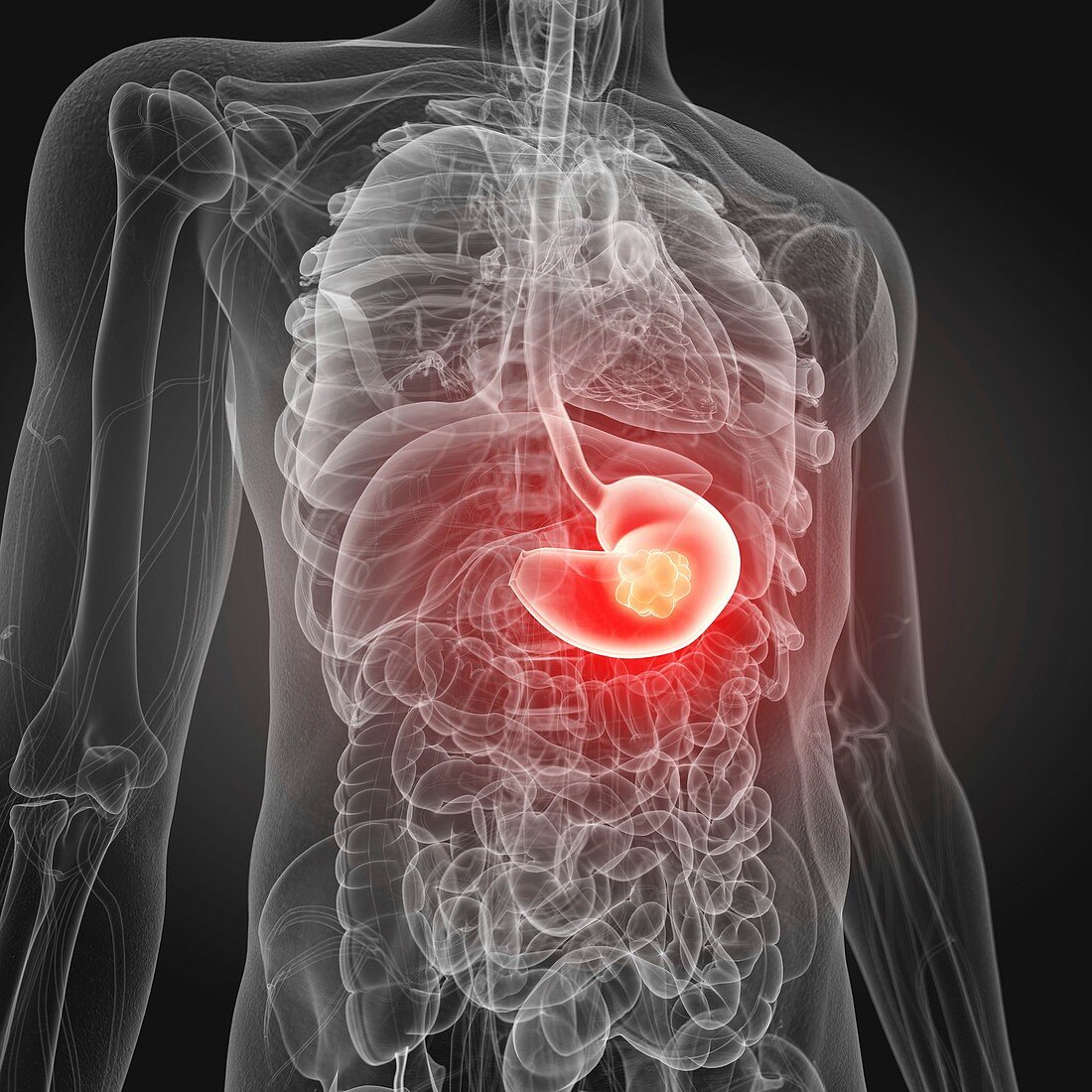 Illustration of stomach cancer