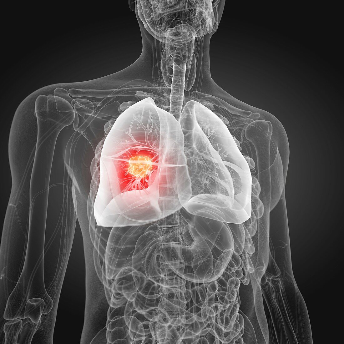 Illustration of lung cancer