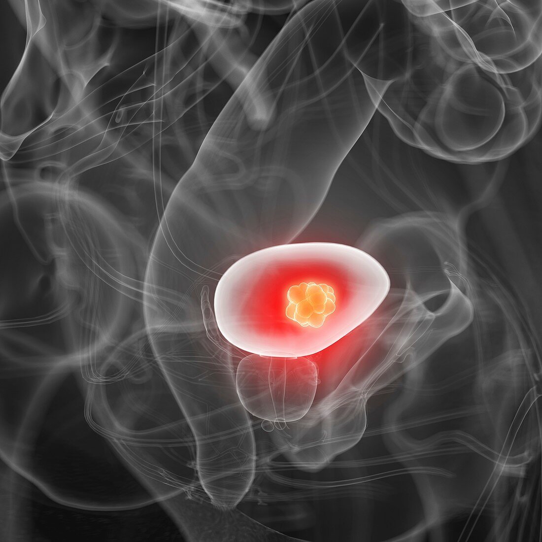 Illustration of bladder cancer