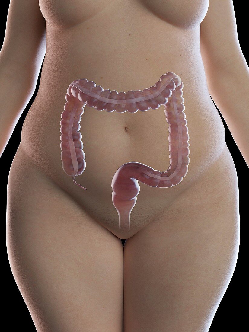 Illustration of an obese woman's colon