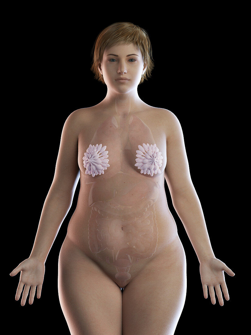 Illustration of an obese woman's mammary glands