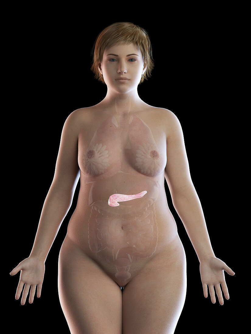 Illustration of an obese woman's pancreas