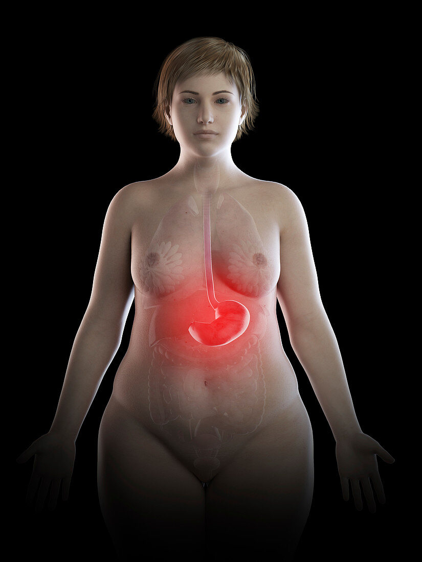 Illustration of an obese woman's painful stomach