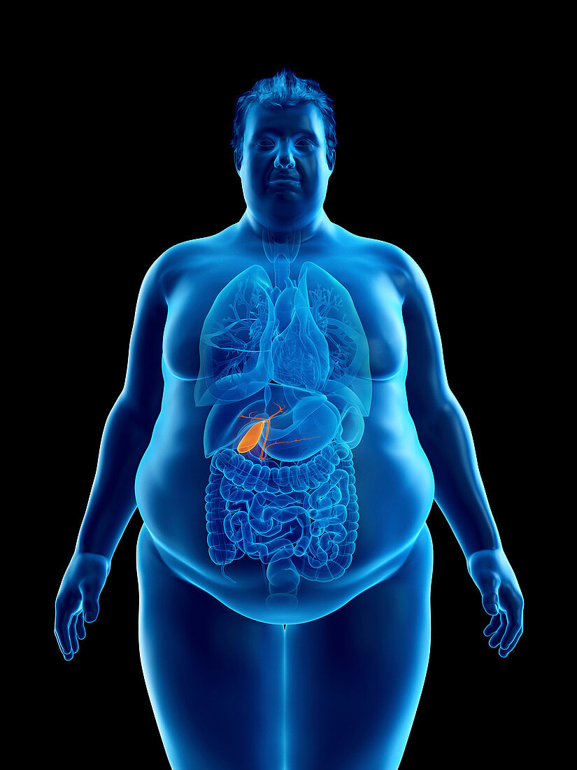 Illustration of an obese man's gallbladder