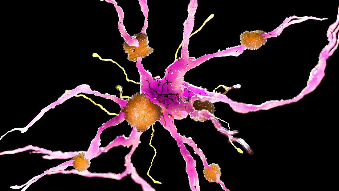 Illustration of amyloid plaques on a nerve cell