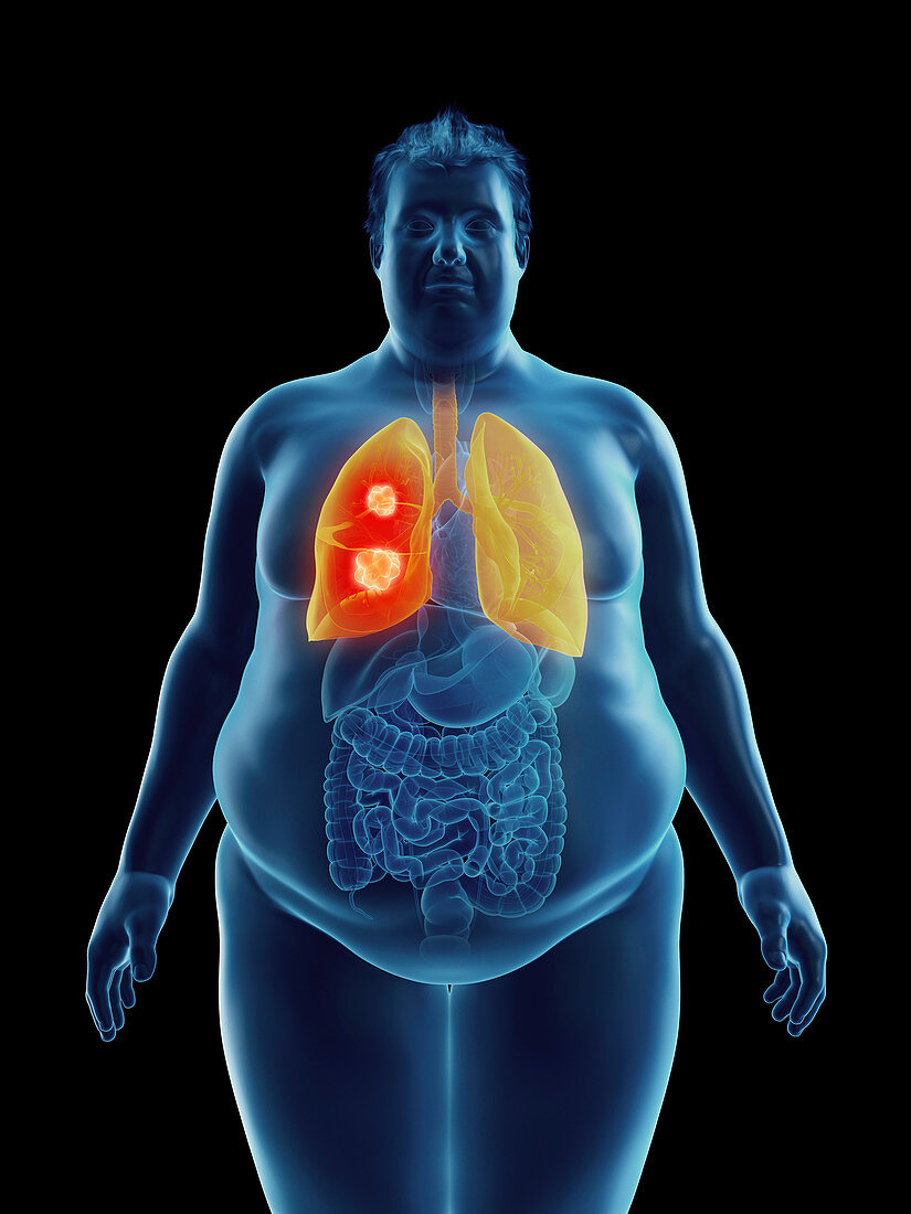 Illustration of an obese man's lung tumor