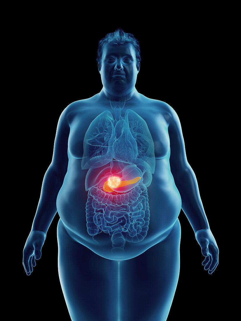 Illustration of an obese man's pancreas tumor