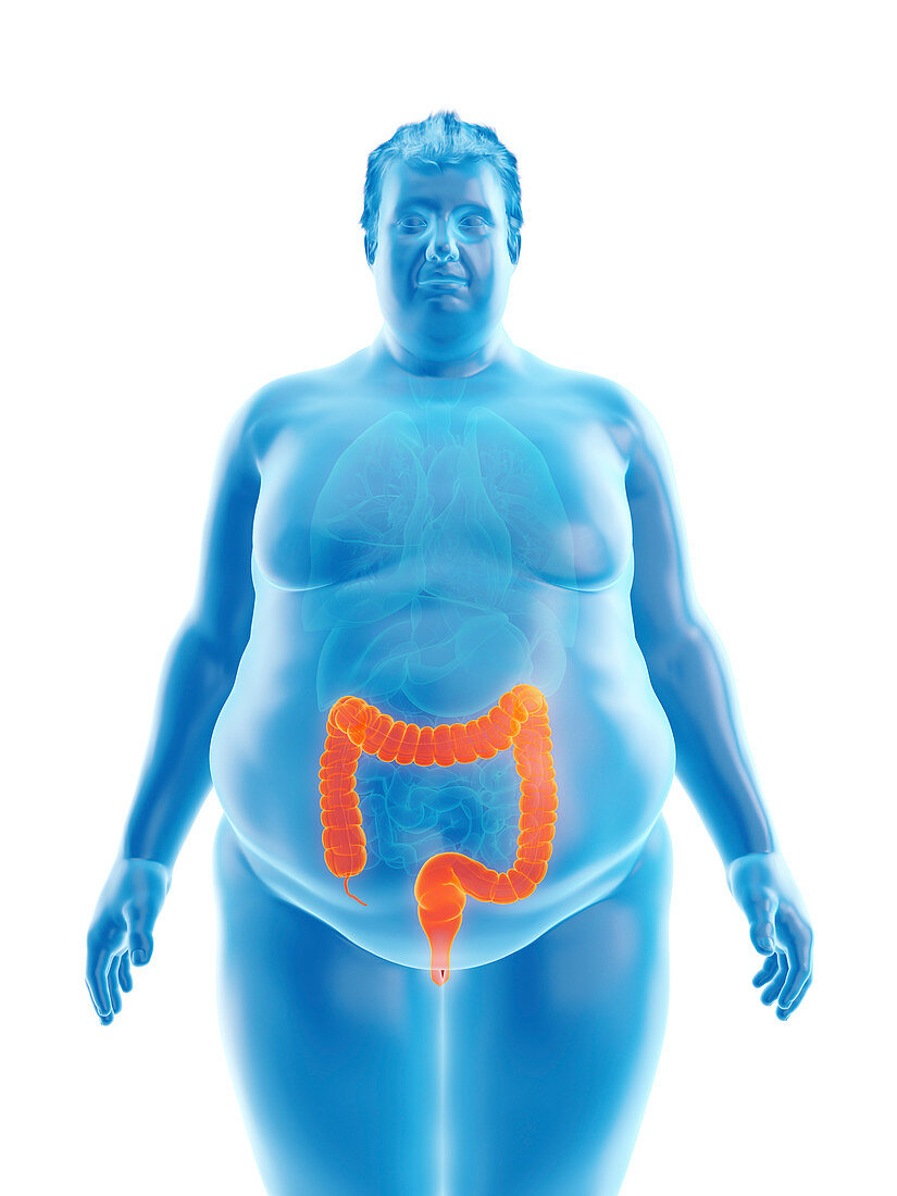 Illustration of an obese man's colon