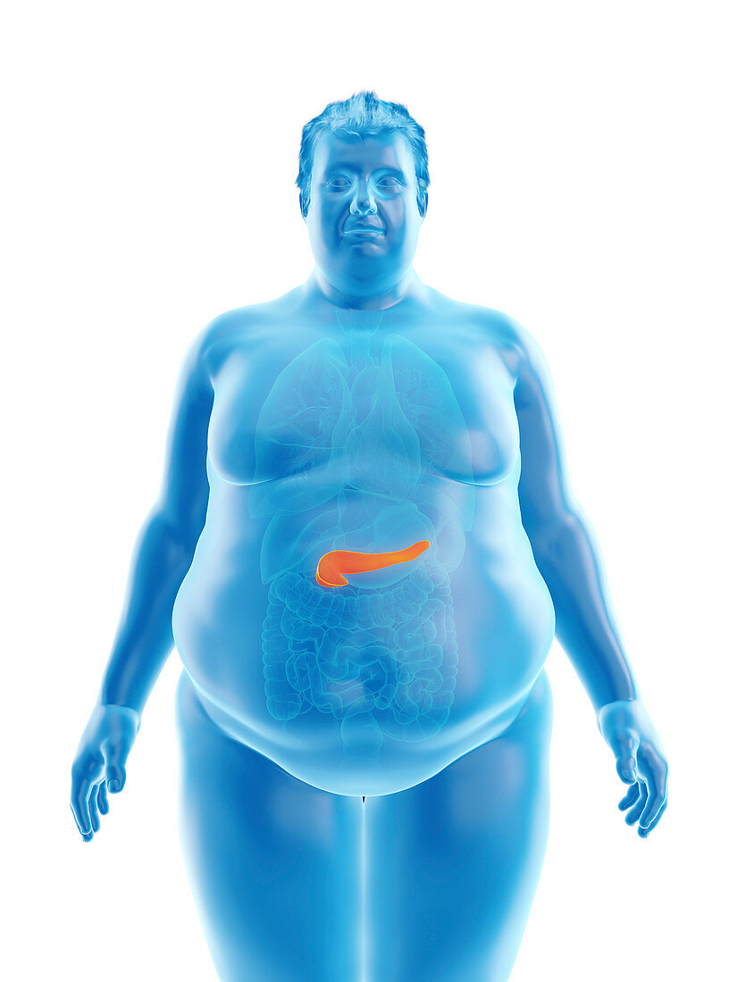 Illustration of an obese man's pancreas