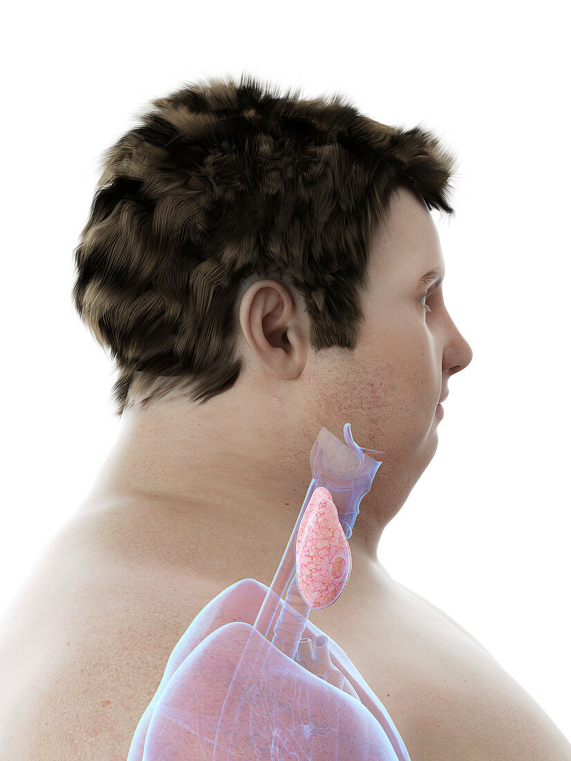 Illustration of an obese man's thyroid gland