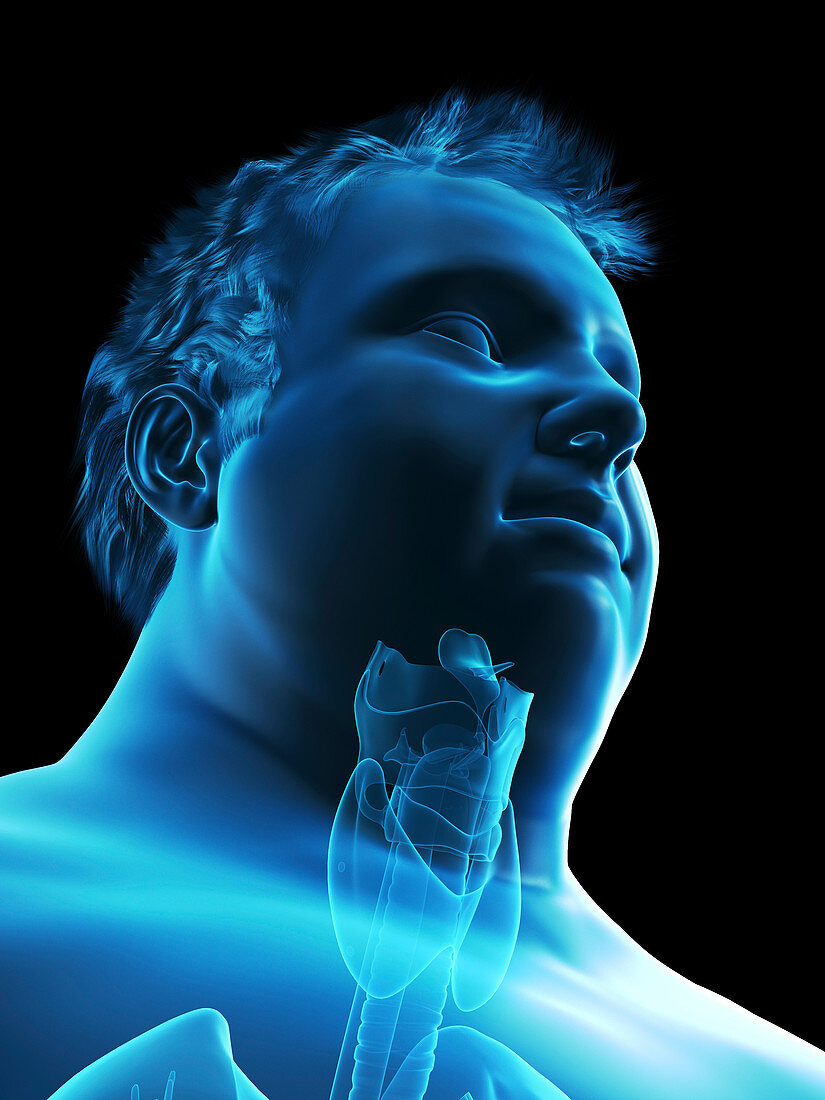 Illustration of an obese man's throat anatomy