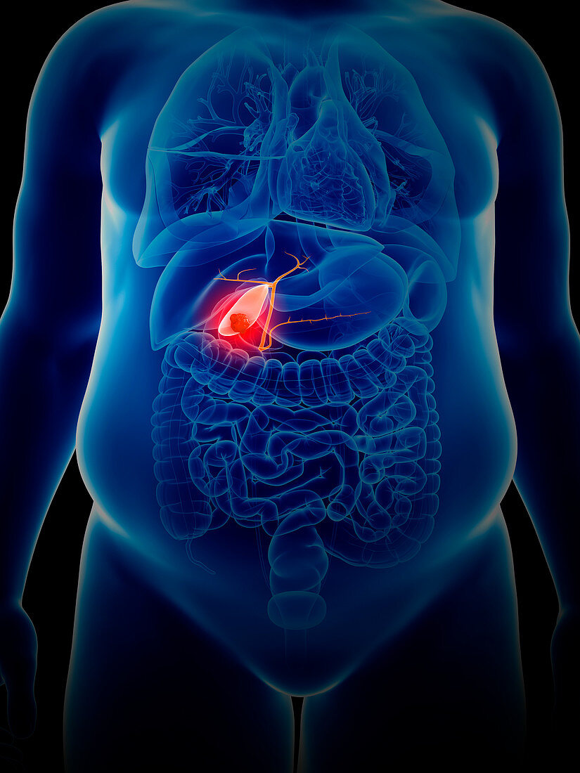 Illustration of gallbladder cancer