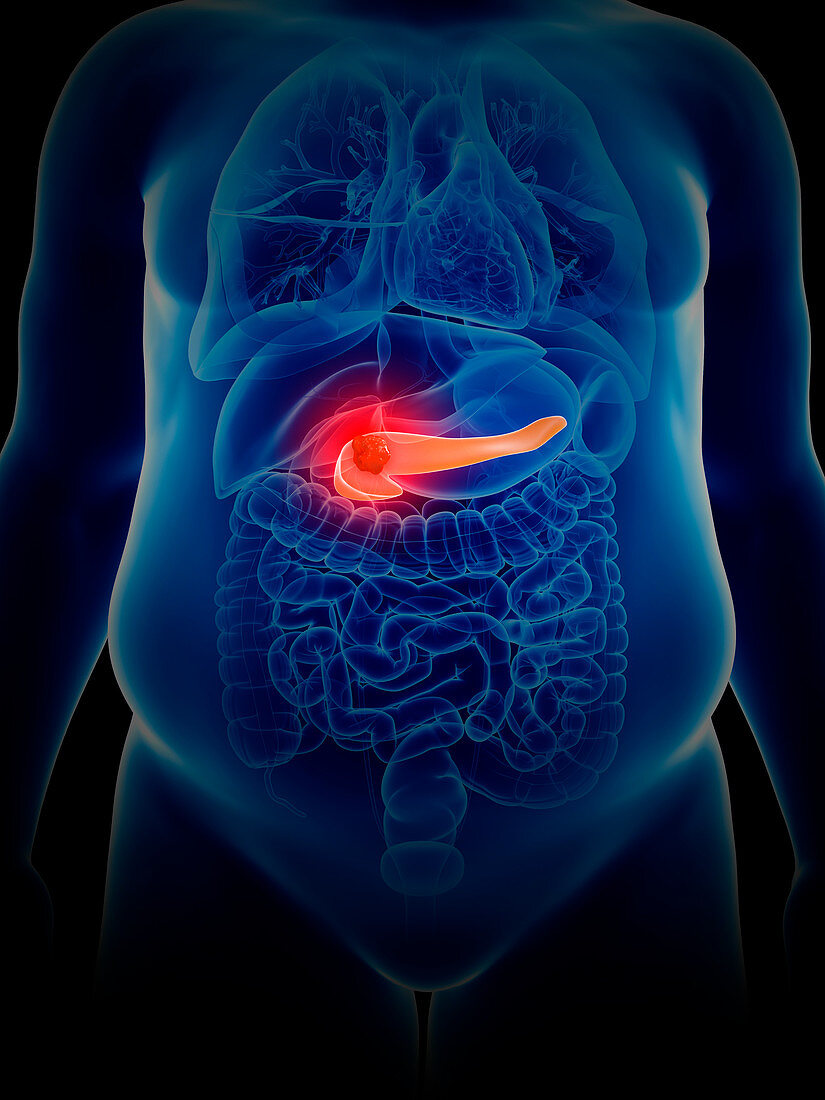 Illustration of pancreas cancer