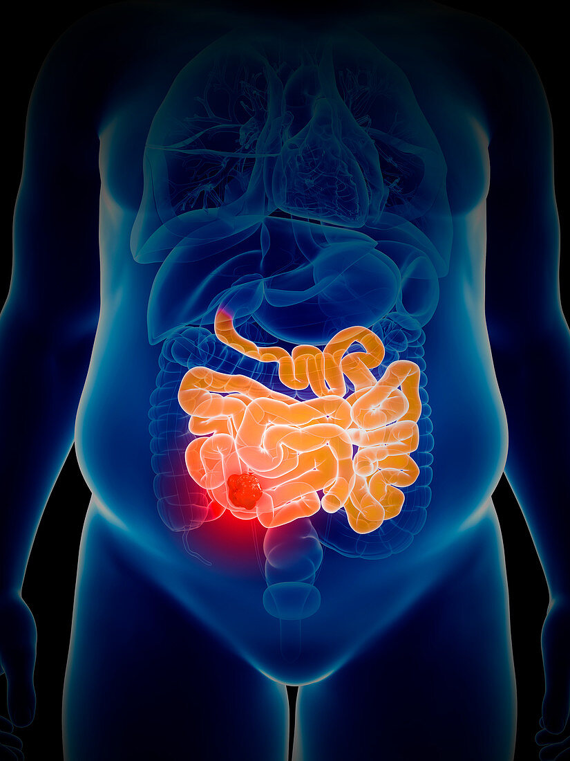 Illustration of bowel cancer