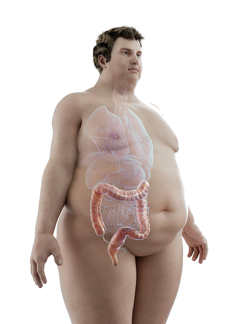 Illustration of an obese man's colon