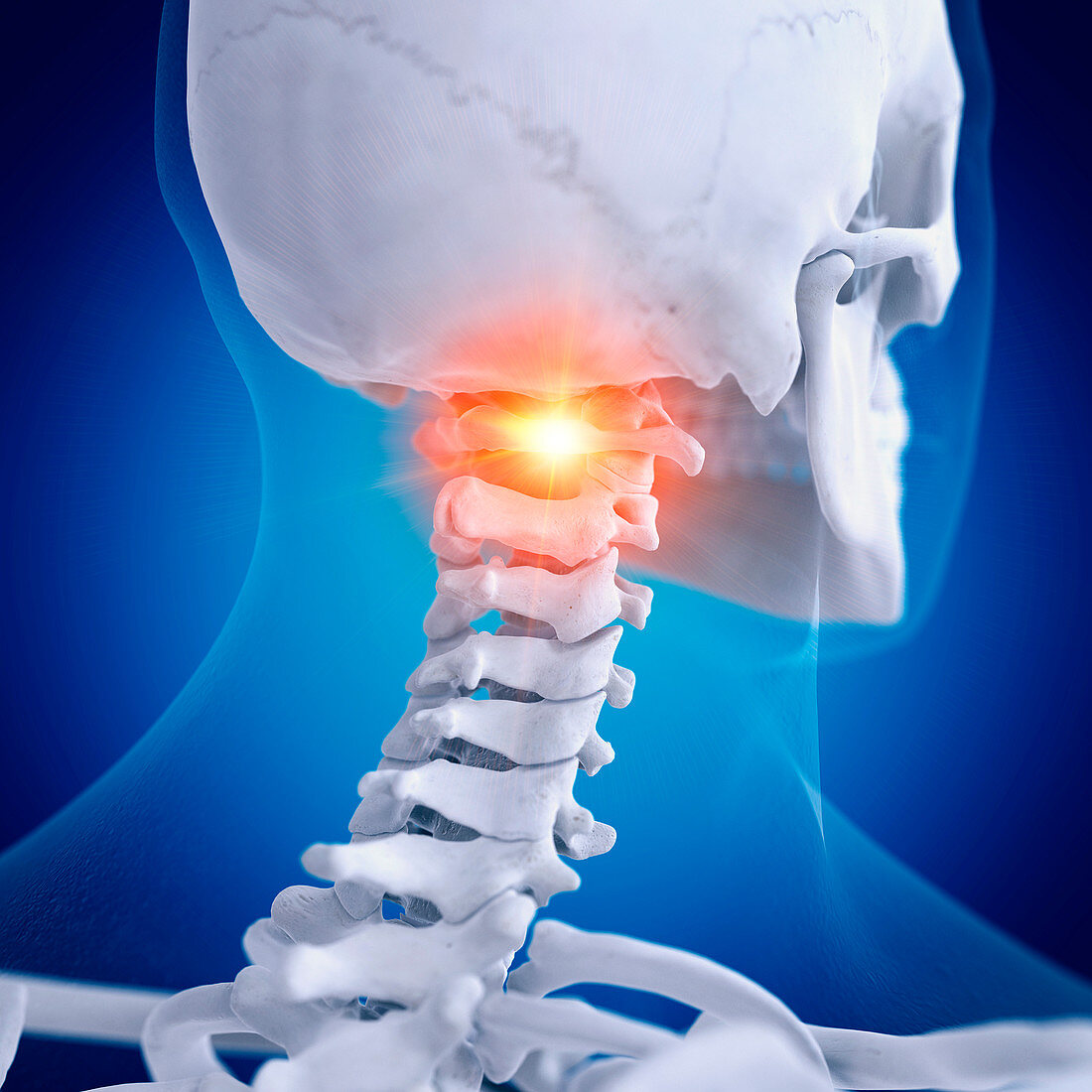 Illustration of a painful atlas vertebrae
