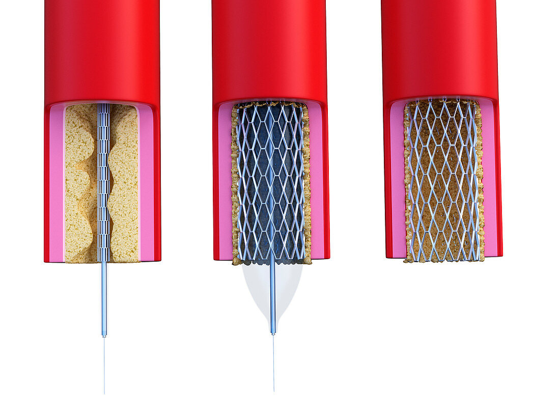 Illustration of a stent being placed