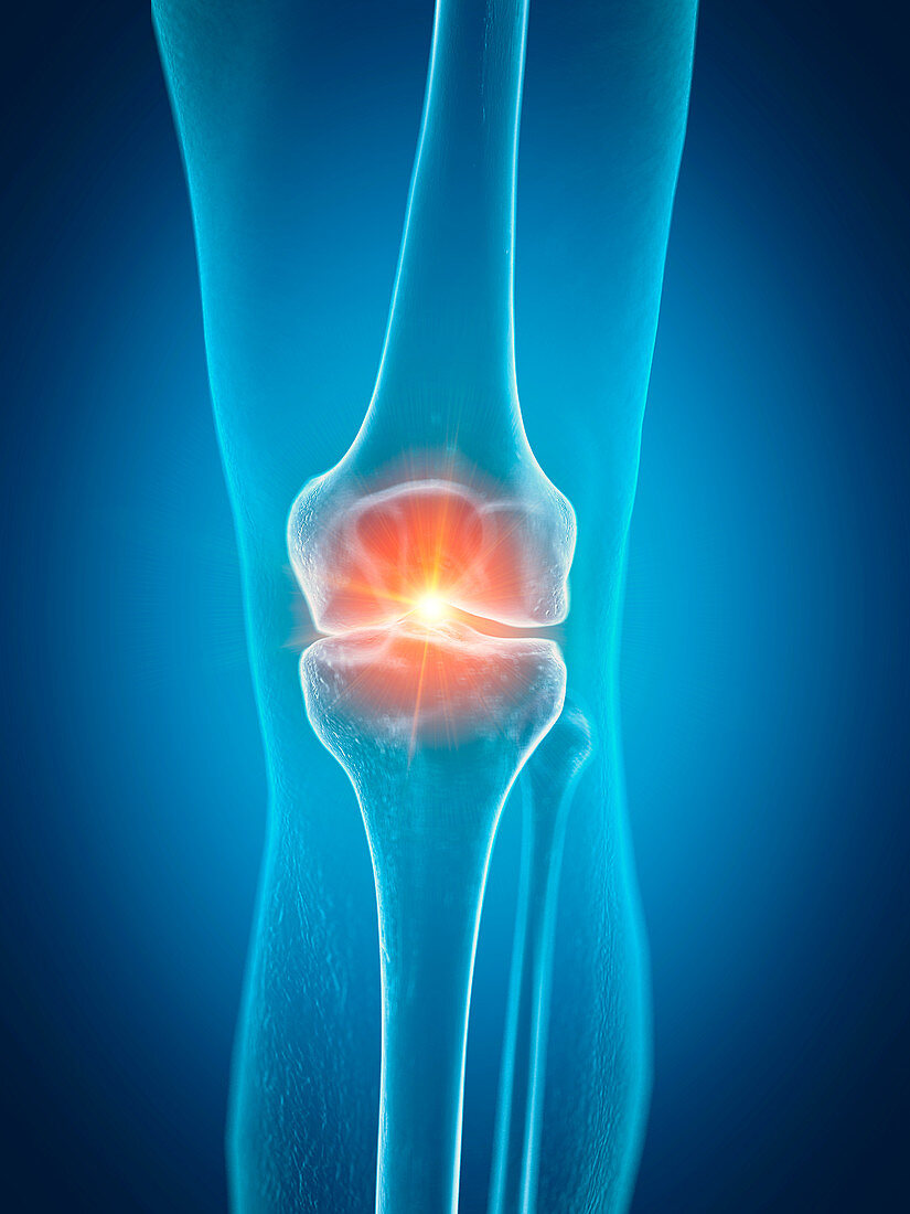 Illustration of a painful knee