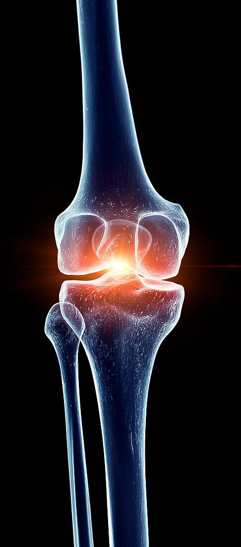 Illustration of a painful knee joint