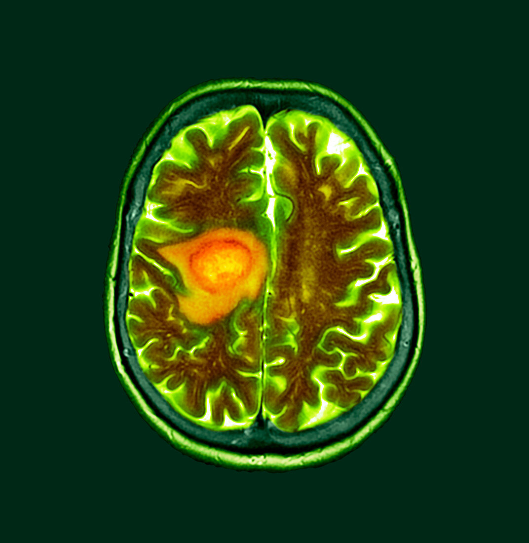 Glioblastoma brain cancer, CT scan