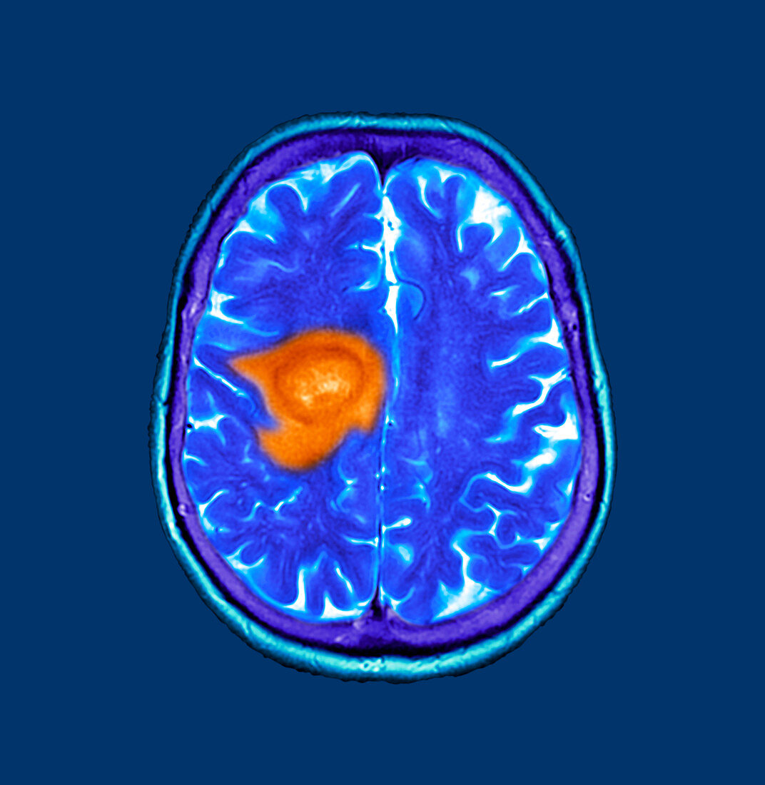 Brain cancer, CT scan