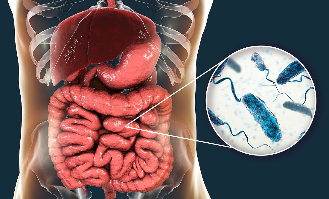 Cholera infection, illustration