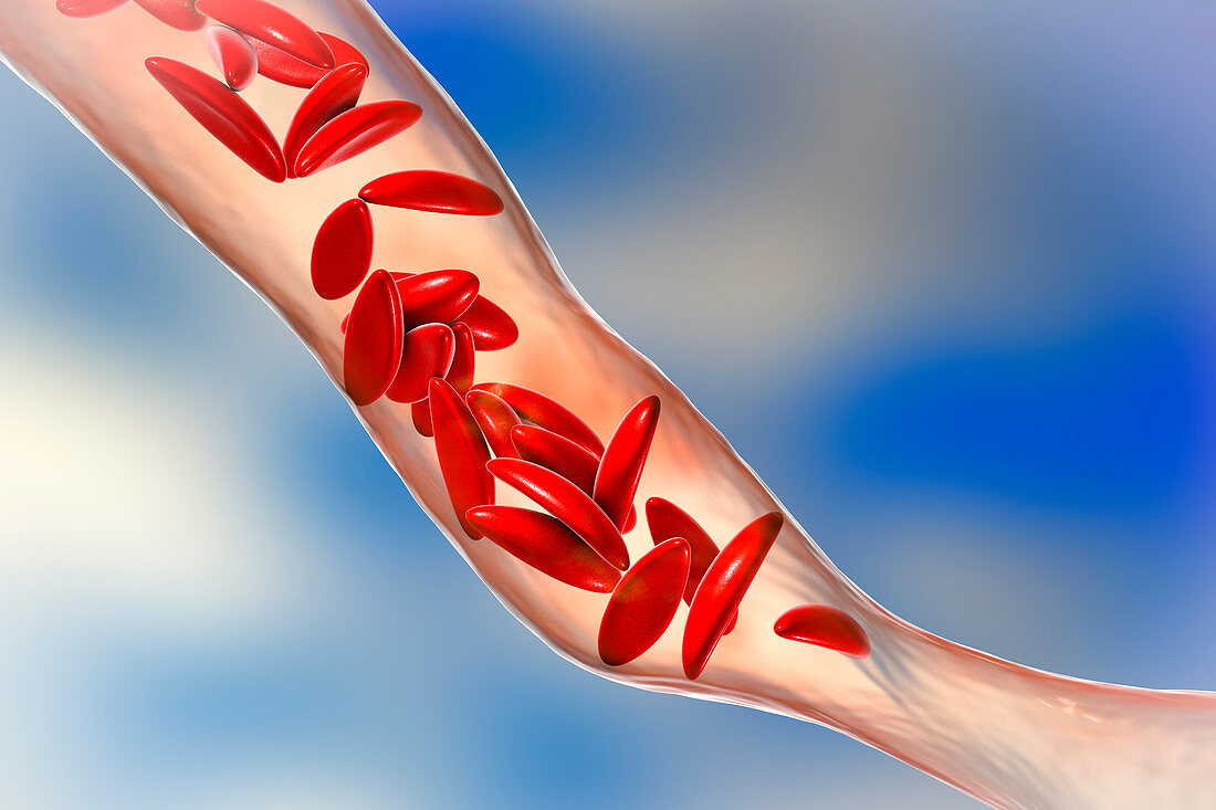 Blood vessel blocked in sickle cell anaemia, illustration