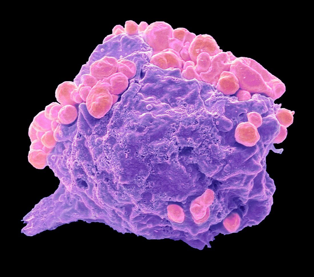 Lymphoma cancer cell, SEM