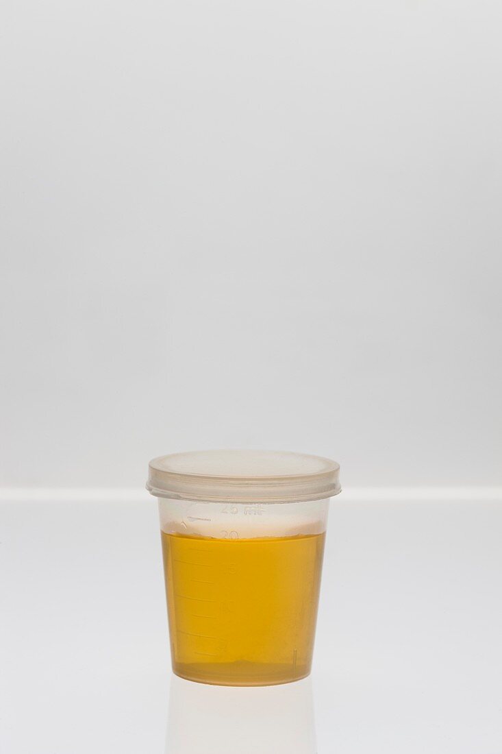 Urine sample in plastic cup