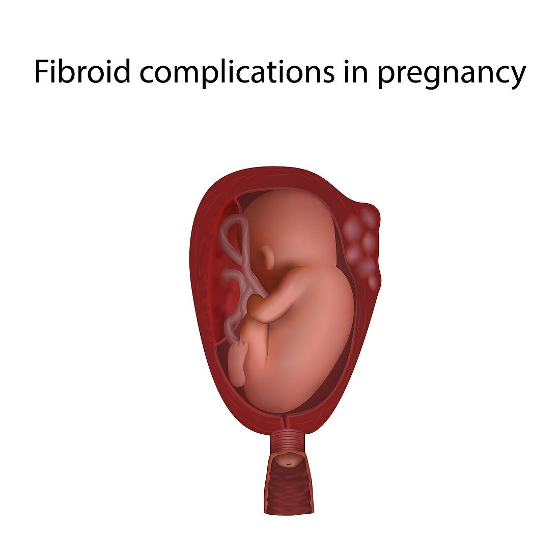 Fibroid complications in pregnancy, illustration