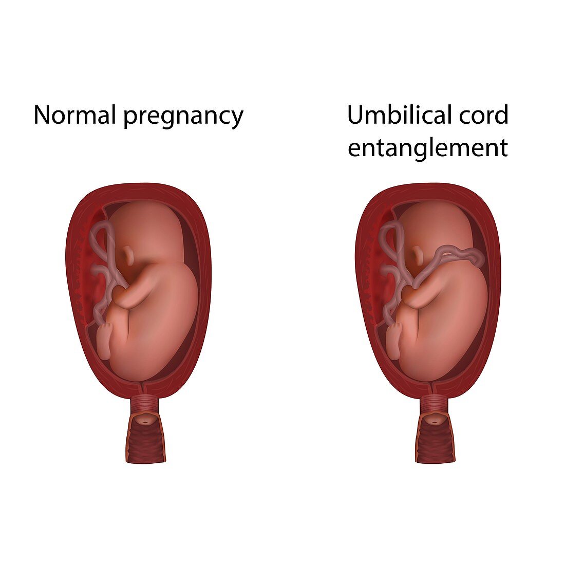 Umbilical cord entanglement in pregnancy, illustration