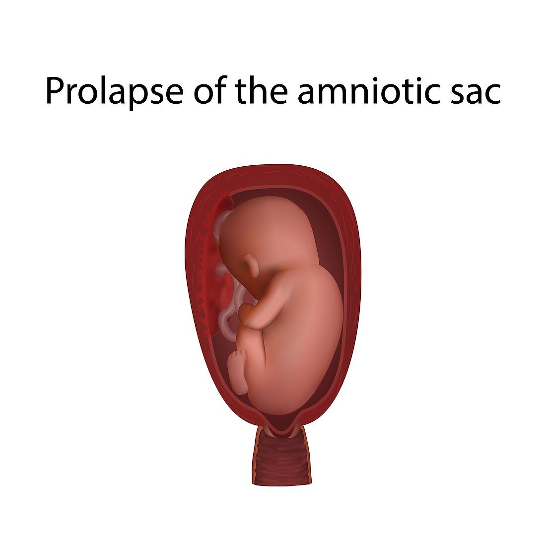 Prolapse of the amniotic sac, illustration
