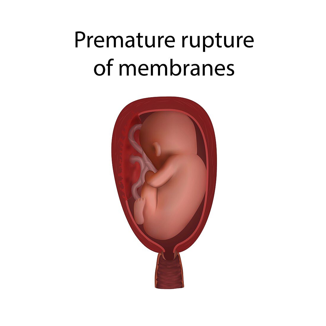 Premature rupture of membranes, illustration