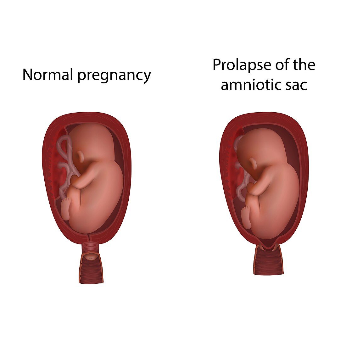 Amniotic sac prolapse and normal pregnancy, illustration