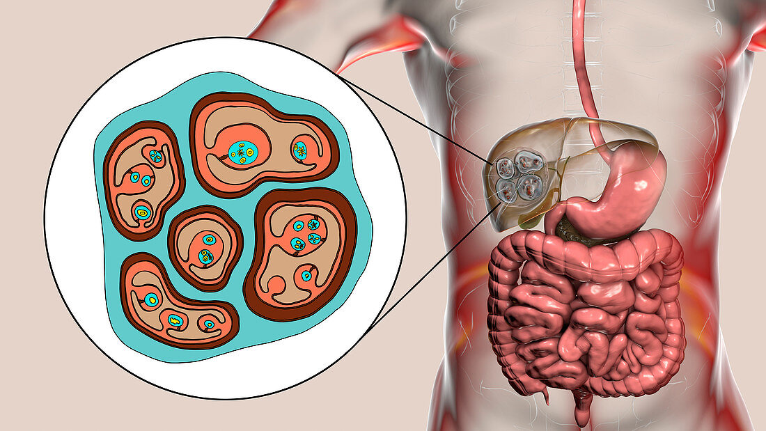 Hydatid disease in liver, alveolar echinococcosis, illustrat