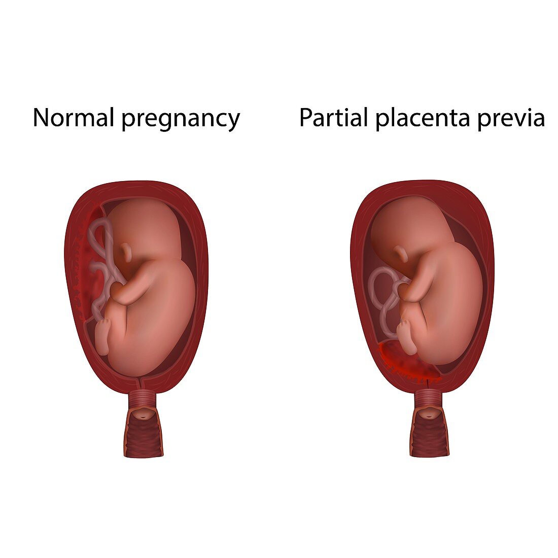 Partial placenta previa and normal pregnancy, illustration