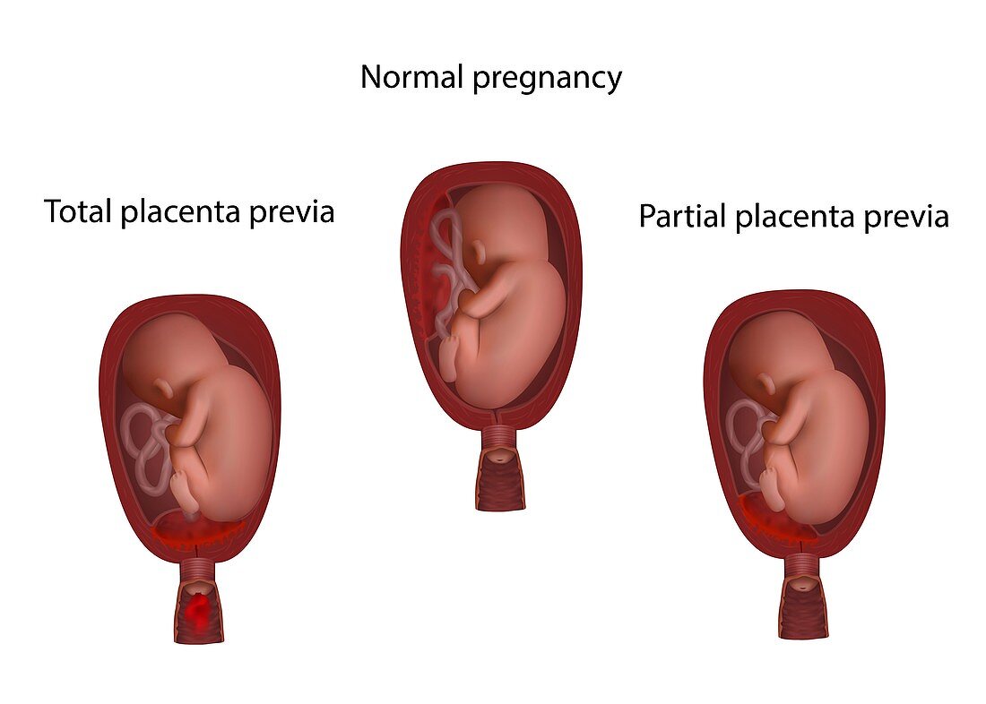 Health, partial and total placenta previa, illustration