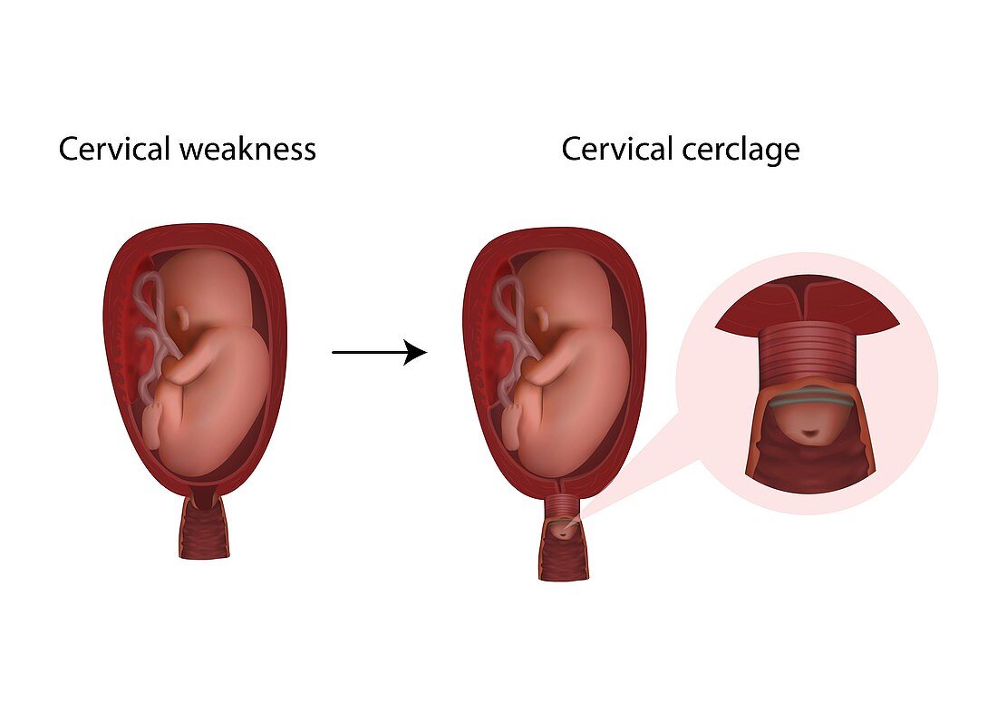 Cervical cerclage, illustration