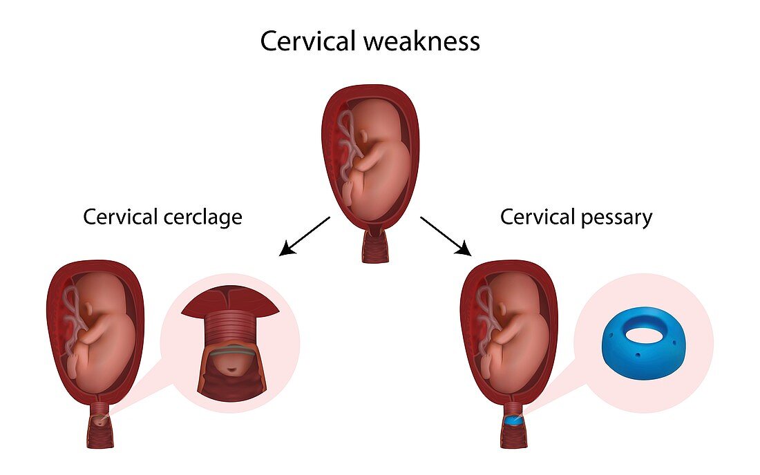 Cervical weakness, cerclage and pessary, illustration