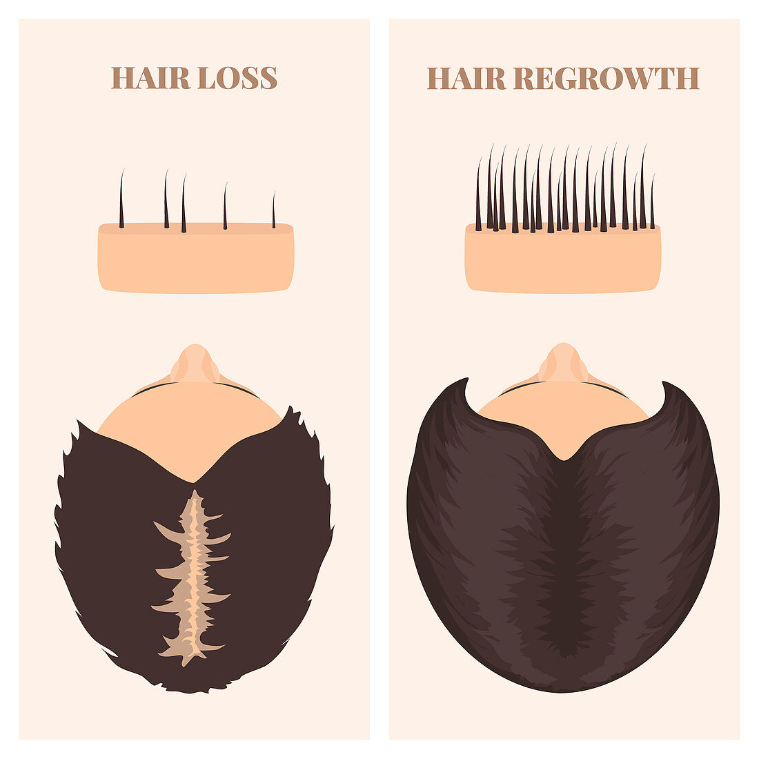 Woman before and after hair transplantation, illustration