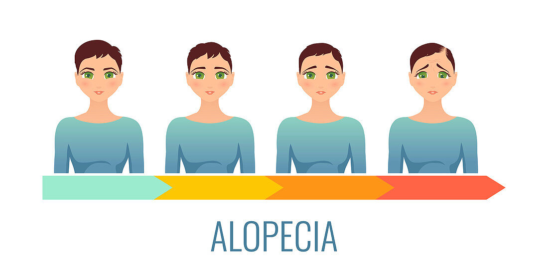 Female alopecia stages, illustration