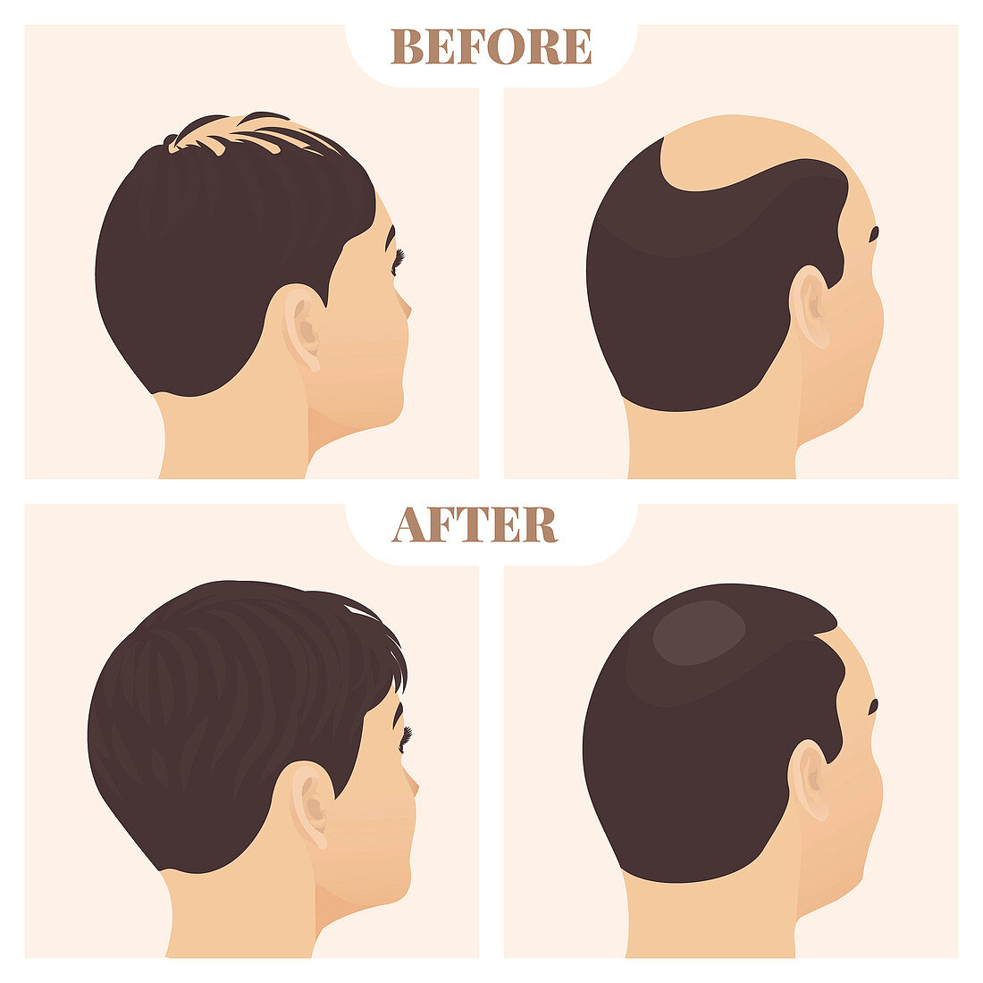 Hair loss treatment result in men and women, illustration