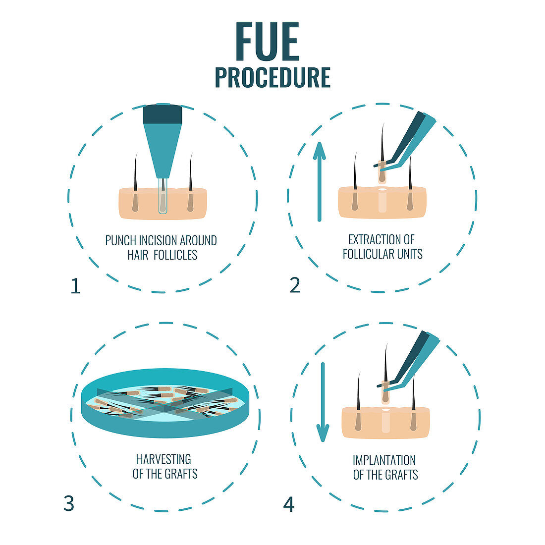 FUE hair transplantation stages, illustration