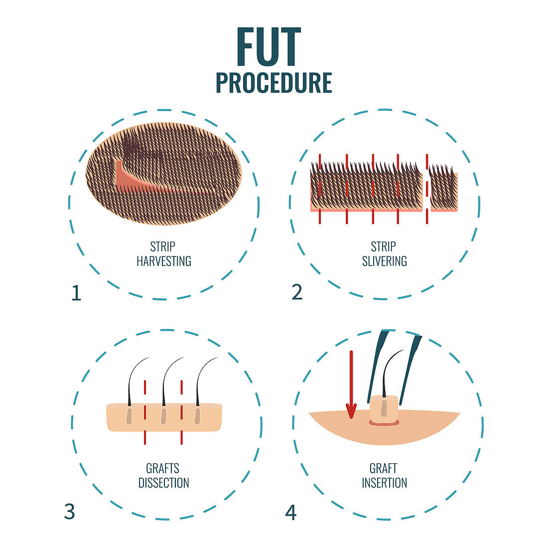 FUT hair transplantation stages, illustration