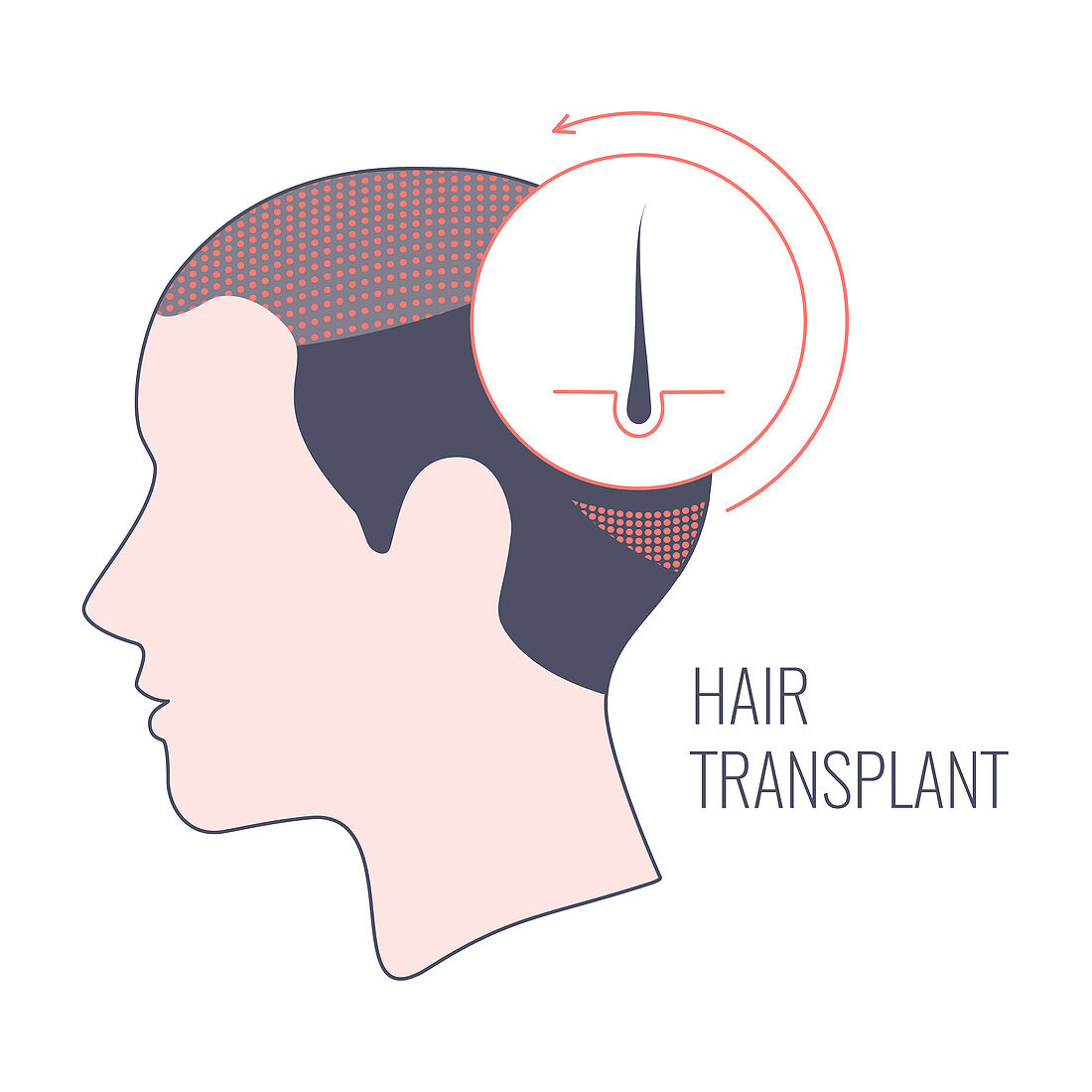 Hair transplantation in women, conceptual illustration